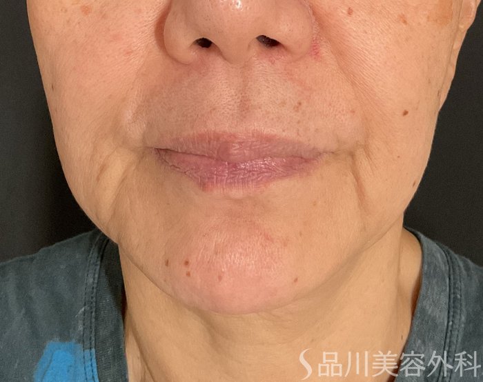症例NO.74906のBEFORE写真