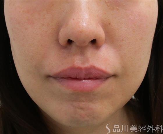 症例NO.43081のBEFORE写真