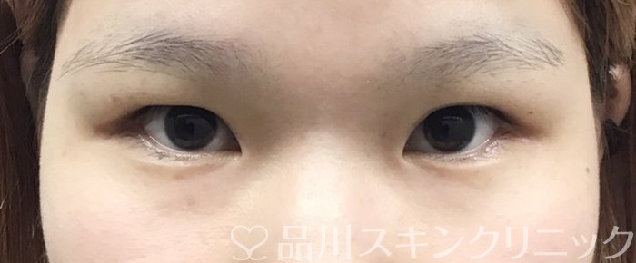 症例NO.63345のBEFORE写真