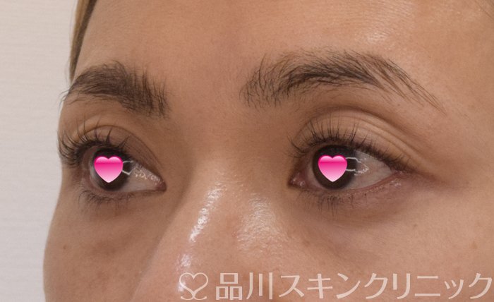 症例NO.74276のBEFORE写真
