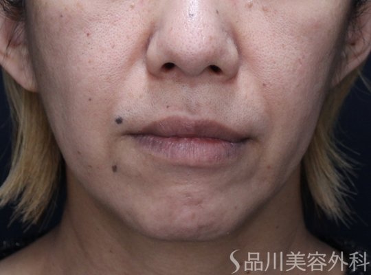 症例NO.73347のBEFORE写真