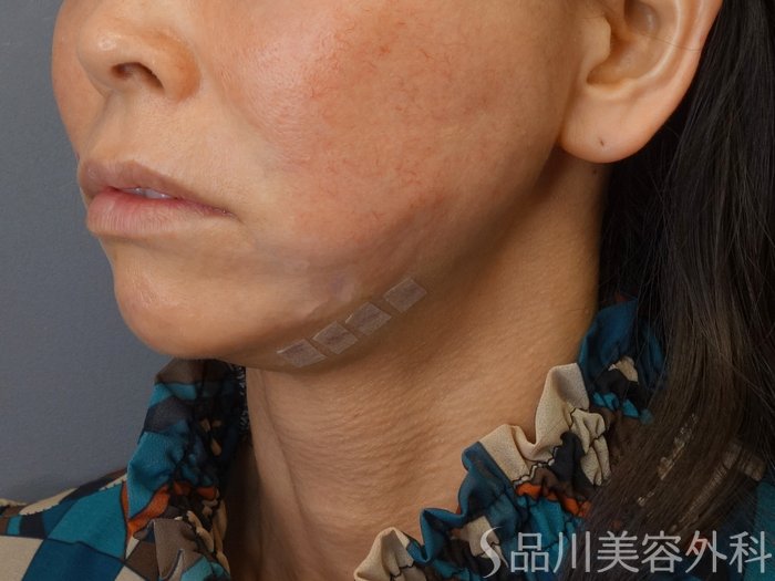 症例NO.72631のAFTER写真