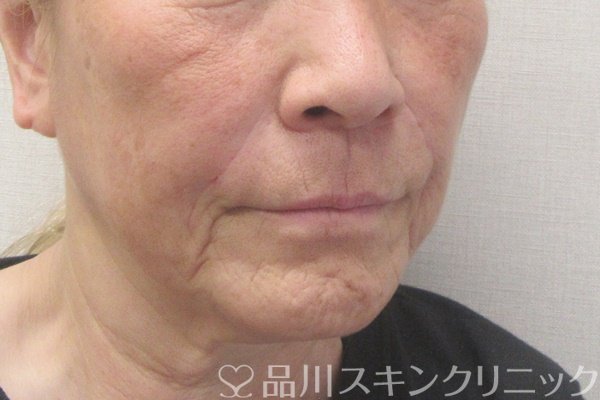 症例NO.70880のAFTER写真