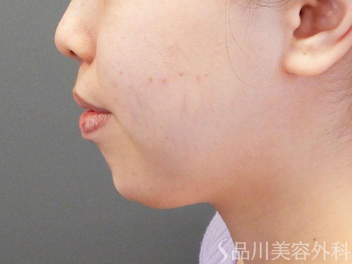 症例NO.70194のAFTER写真