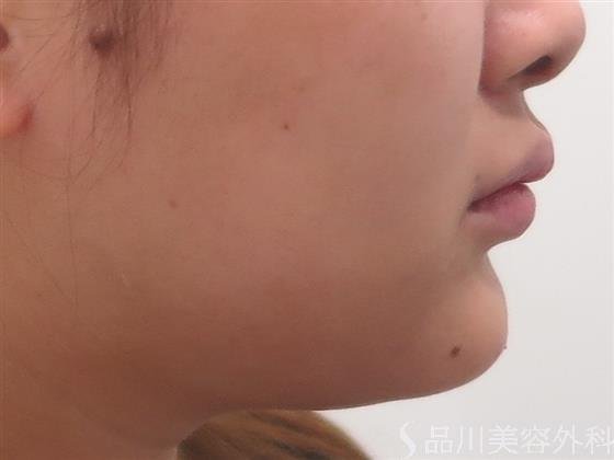 症例NO.44059のAFTER写真