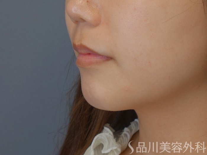 症例NO.71697のBEFORE写真