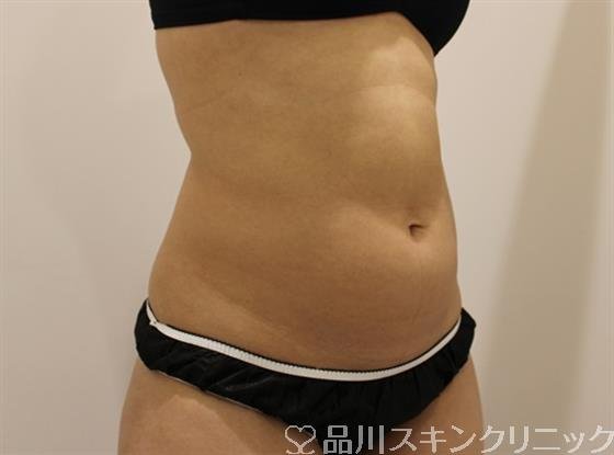 症例NO.46888のAFTER写真