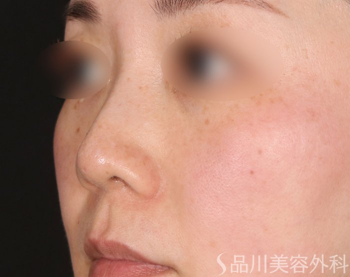 症例NO.73191のAFTER写真