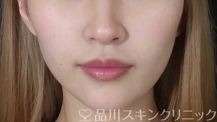 症例NO.71640のAFTER写真