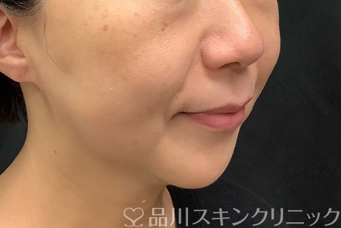 症例NO.69779のBEFORE写真