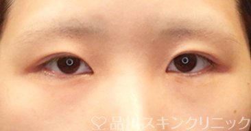症例NO.65680のBEFORE写真