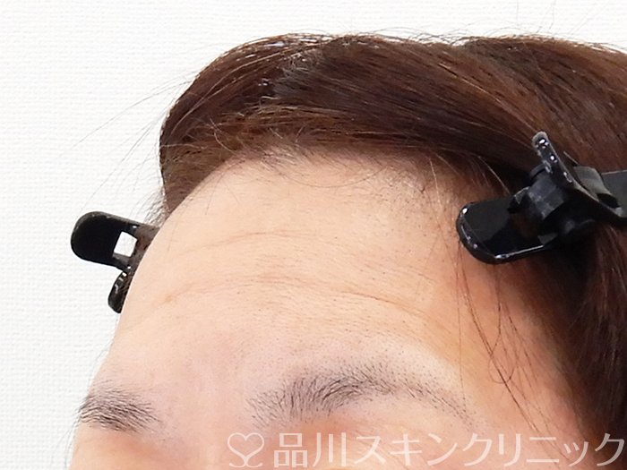 症例NO.62192のBEFORE写真