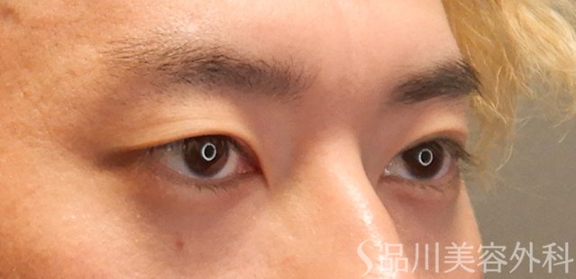 症例NO.72590のBEFORE写真