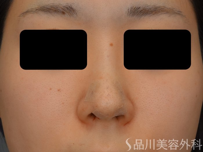 症例NO.74676のAFTER写真