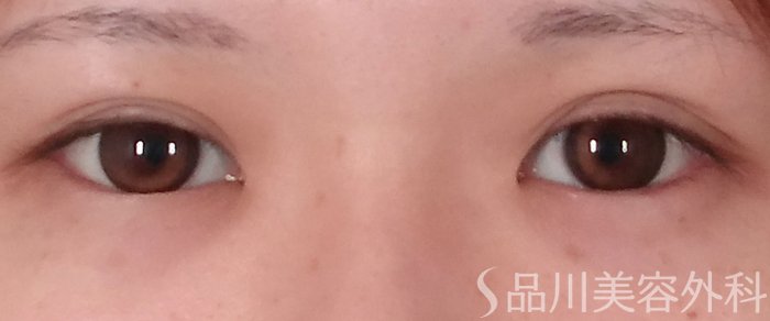 症例NO.69623のBEFORE写真