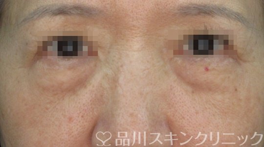 症例NO.71356のBEFORE写真