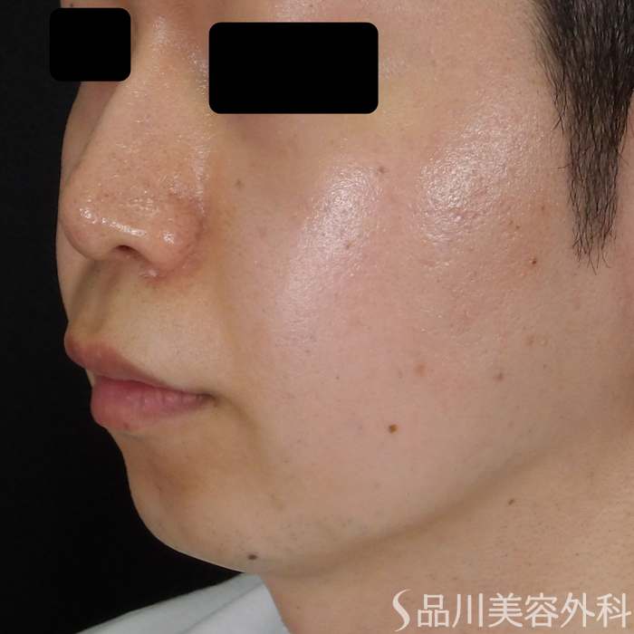 症例NO.71589のBEFORE写真