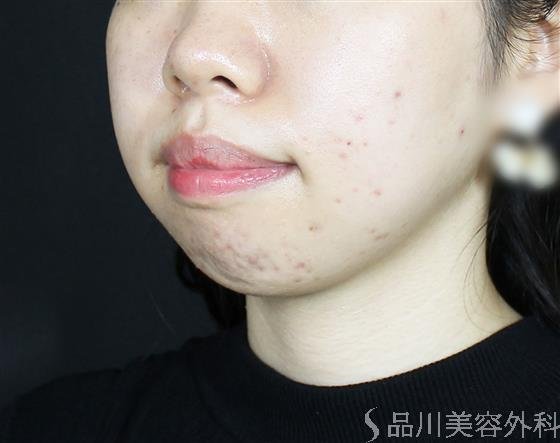 症例NO.61894のBEFORE写真