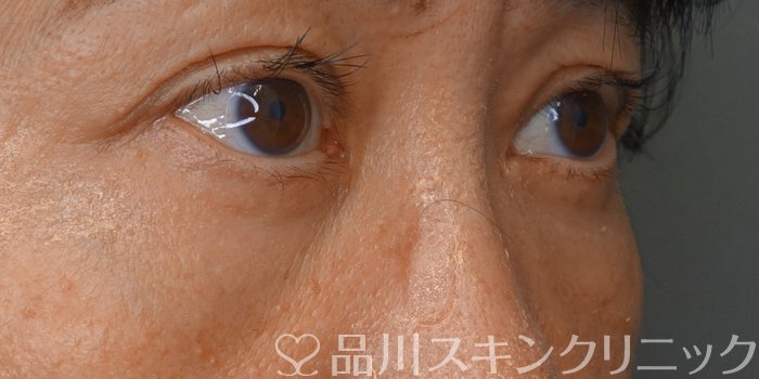 症例NO.71475のBEFORE写真
