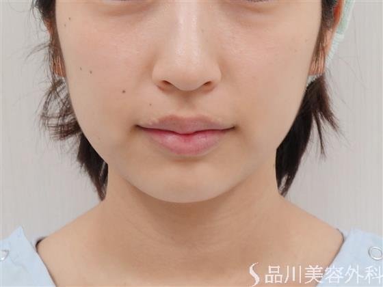 症例NO.42921のBEFORE写真