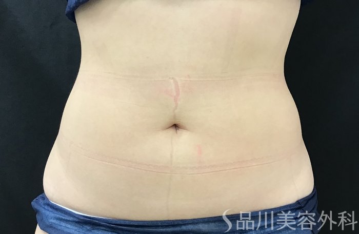 症例NO.68158のAFTER写真