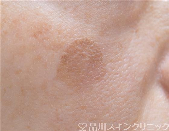症例NO.58915のBEFORE写真