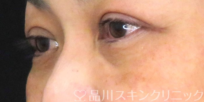 症例NO.62415のBEFORE写真