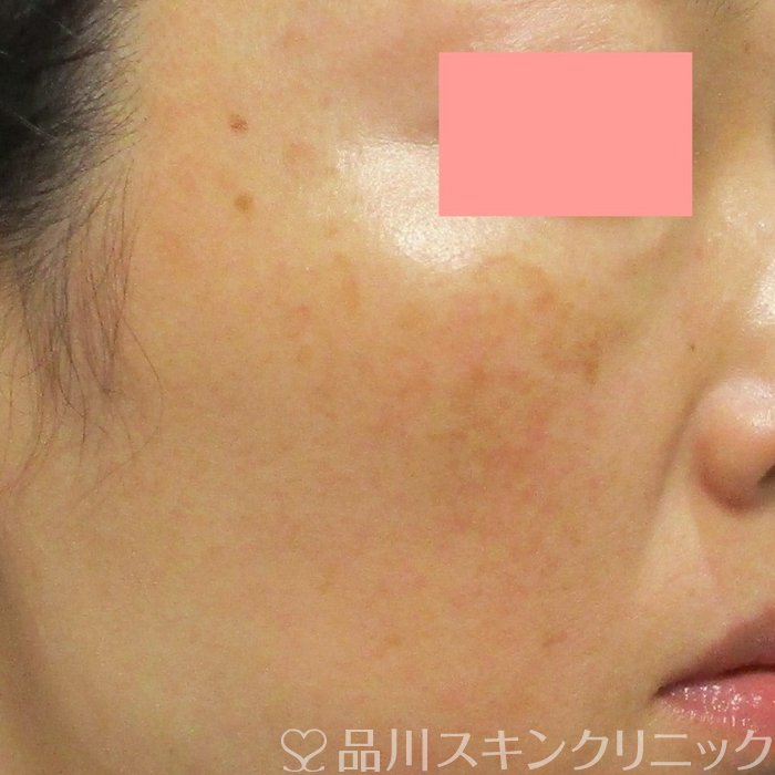 症例NO.70998のBEFORE写真