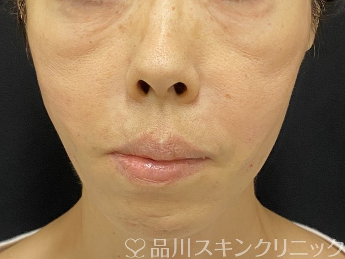 症例NO.74000のAFTER写真