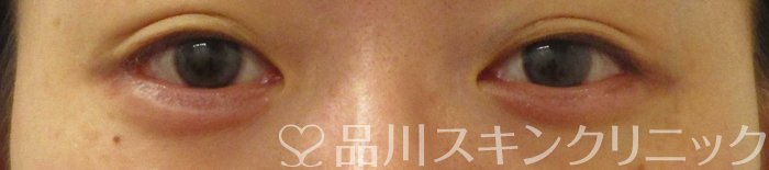 症例NO.65338のAFTER写真