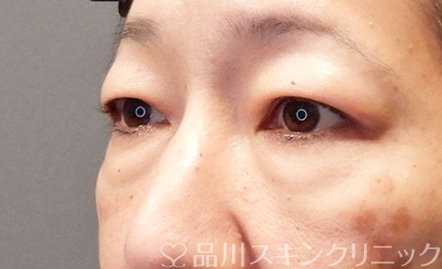 症例NO.68166のBEFORE写真