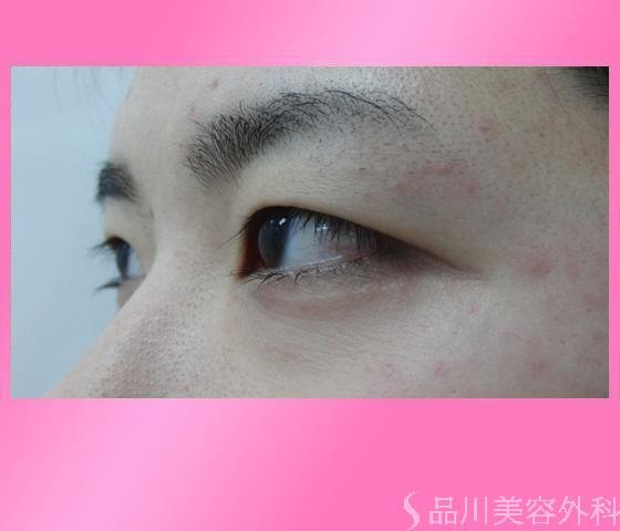 症例NO.4087のBEFORE写真