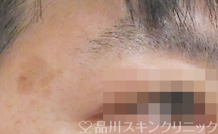 症例NO.63041のBEFORE写真