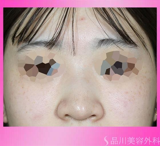 症例NO.54993のBEFORE写真