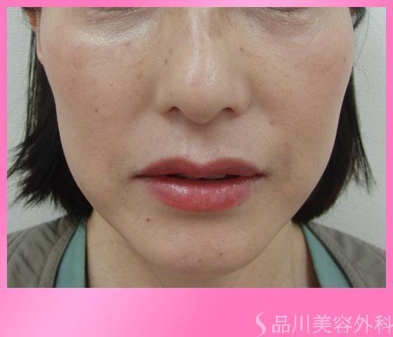 症例NO.2852のAFTER写真
