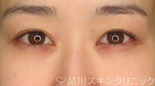 症例NO.71009のBEFORE写真