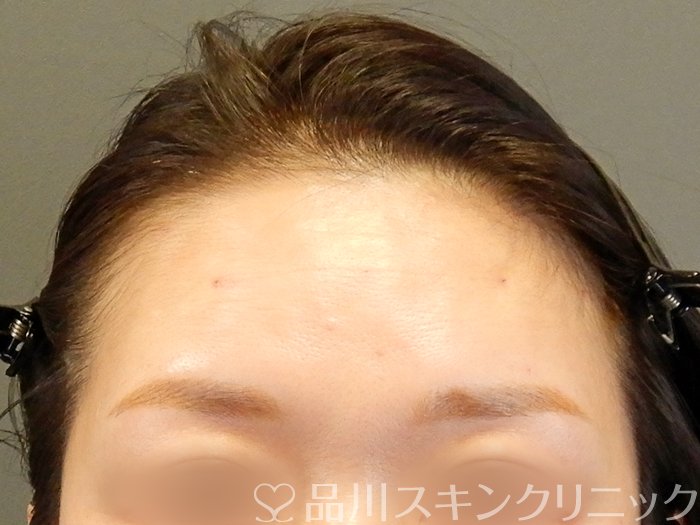 症例NO.63542のAFTER写真
