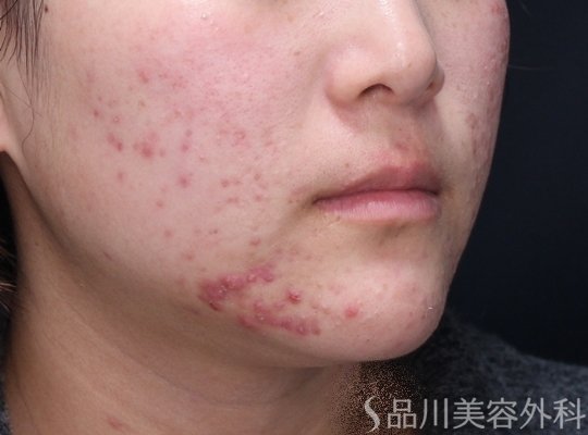 症例NO.73012のBEFORE写真