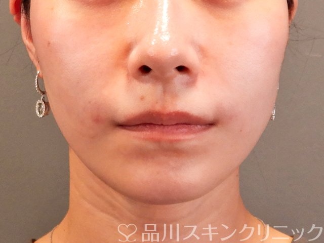 症例NO.70322のAFTER写真