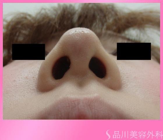 症例NO.2950のAFTER写真