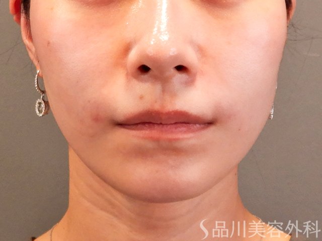 症例NO.70322のAFTER写真