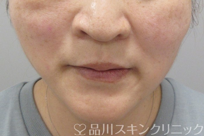 症例NO.70581のAFTER写真