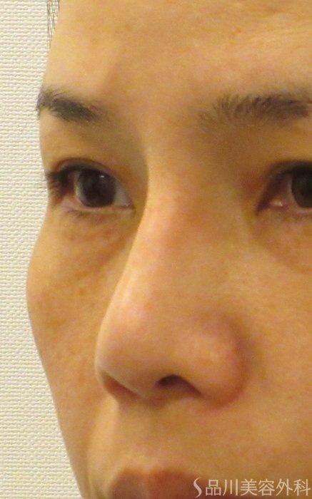 症例NO.69302のAFTER写真