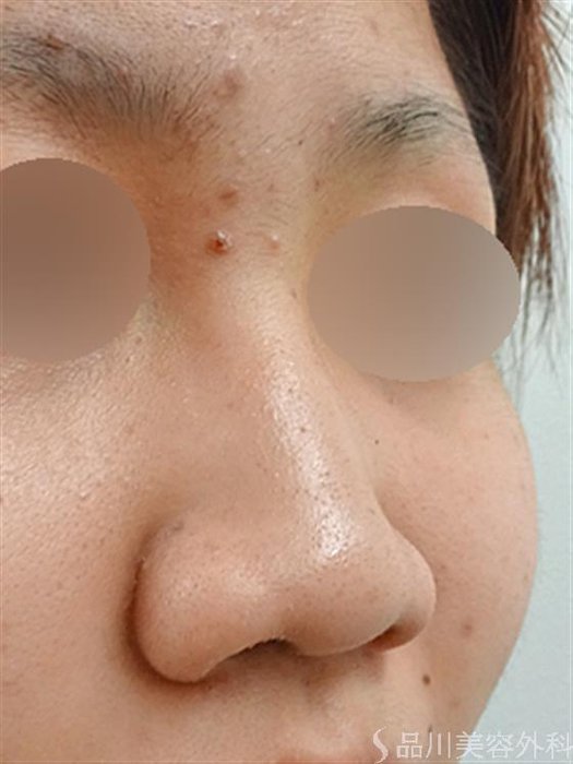 症例NO.34435のBEFORE写真