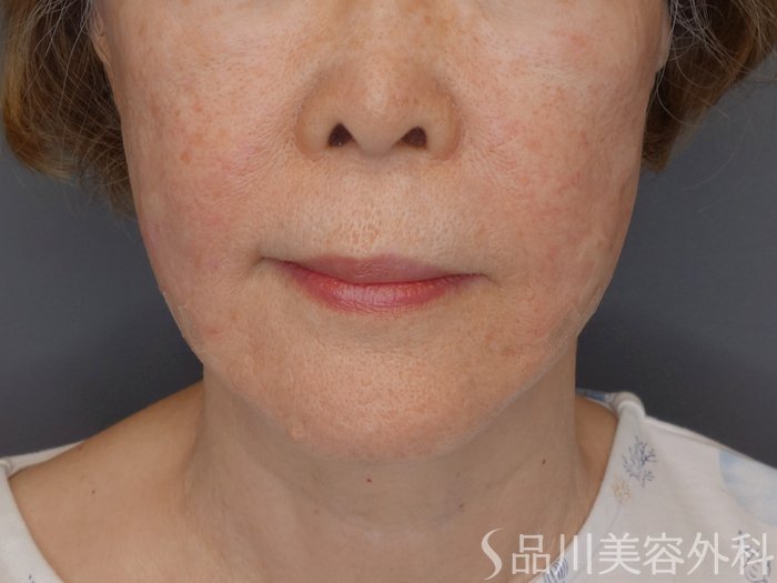 症例NO.71751のAFTER写真