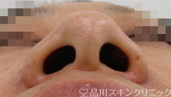 症例NO.38476のBEFORE写真