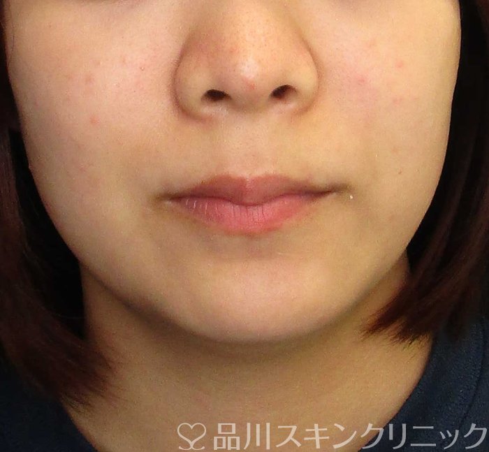 症例NO.65527のAFTER写真