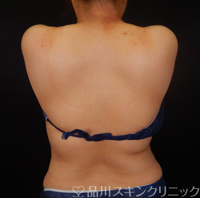 症例NO.66765のAFTER写真