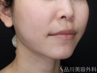 症例NO.72191のAFTER写真