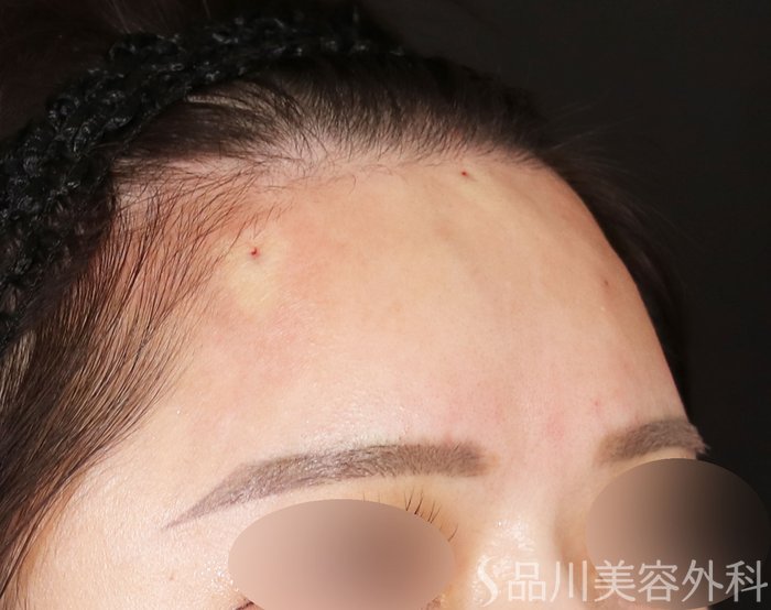 症例NO.71951のAFTER写真